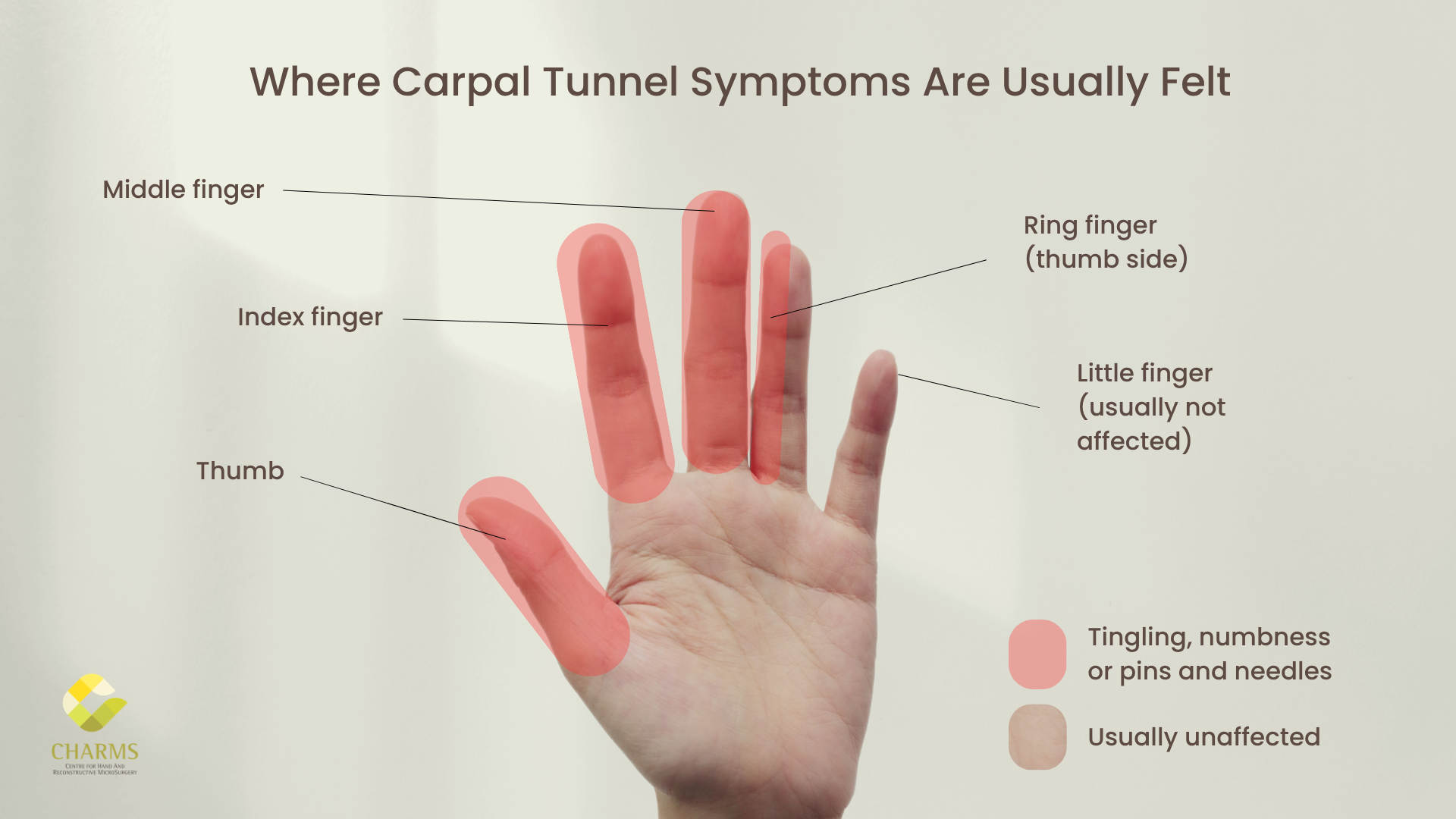 Hand diagram showing where carpal tunnel symptoms such as tingling, numbness or pins and needles are usually felt: the thumb, index finger, middle finger and thumb side of the ring finger, with the little finger usually not affected