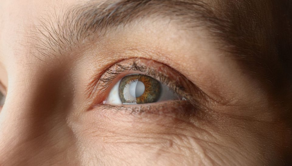 cataract-cloudy-lens-eye-close-up