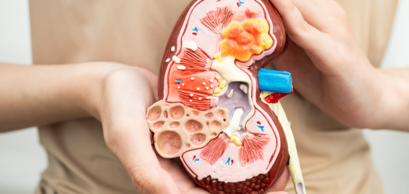 Hands holding a cross-section model of a human kidney showing its internal structure, including a cyst, a tumour and kidney stones