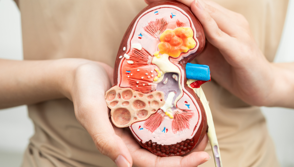 Hands holding a cross-section model of a human kidney showing its internal structure, including a cyst, a tumour and kidney stones