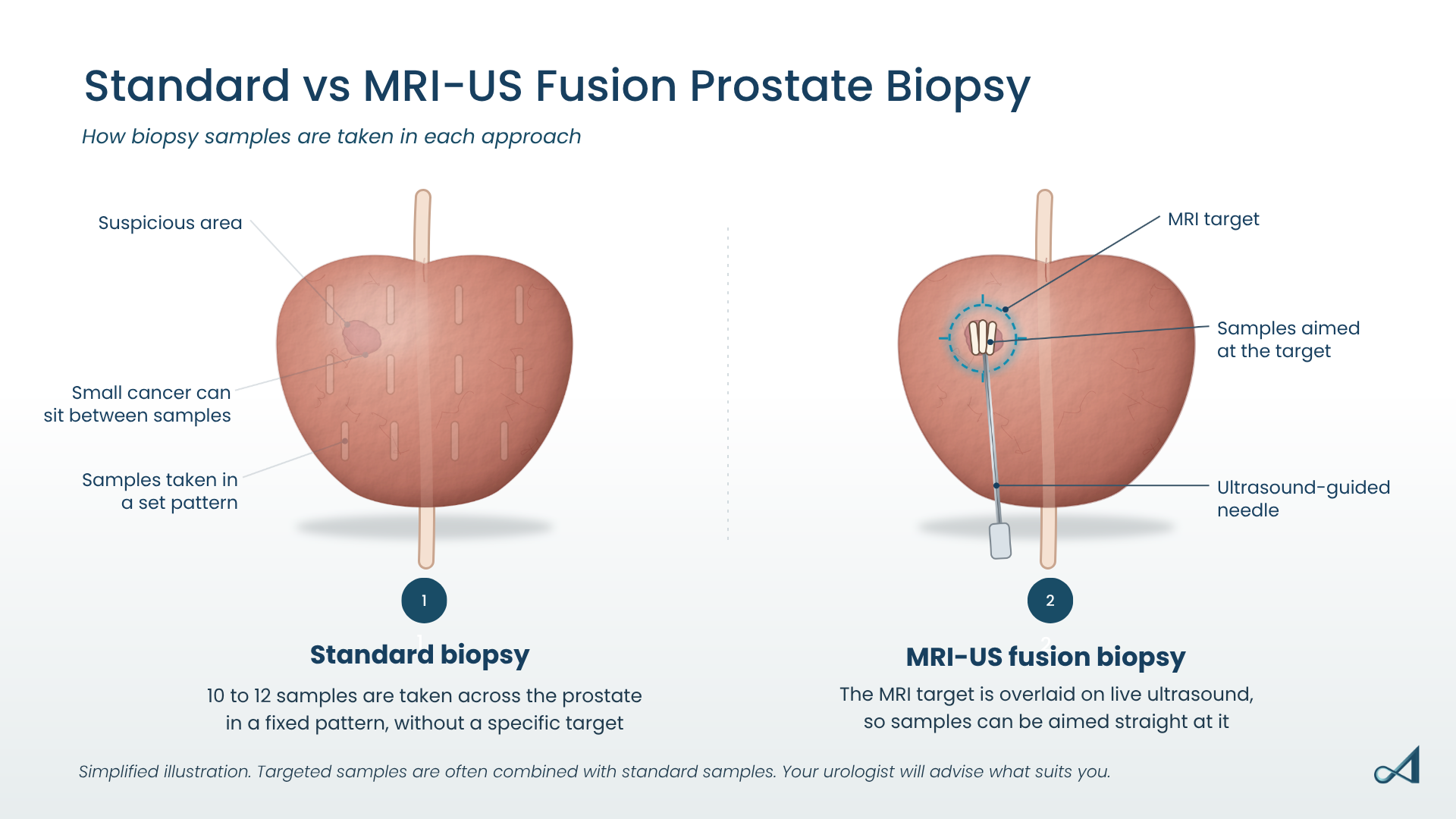Comparison of a standard prostate biopsy, where 10 to 12 samples are taken in a fixed pattern and can miss a small cancer, with an MRI-US fusion biopsy, where samples are aimed at a suspicious area marked on MRI