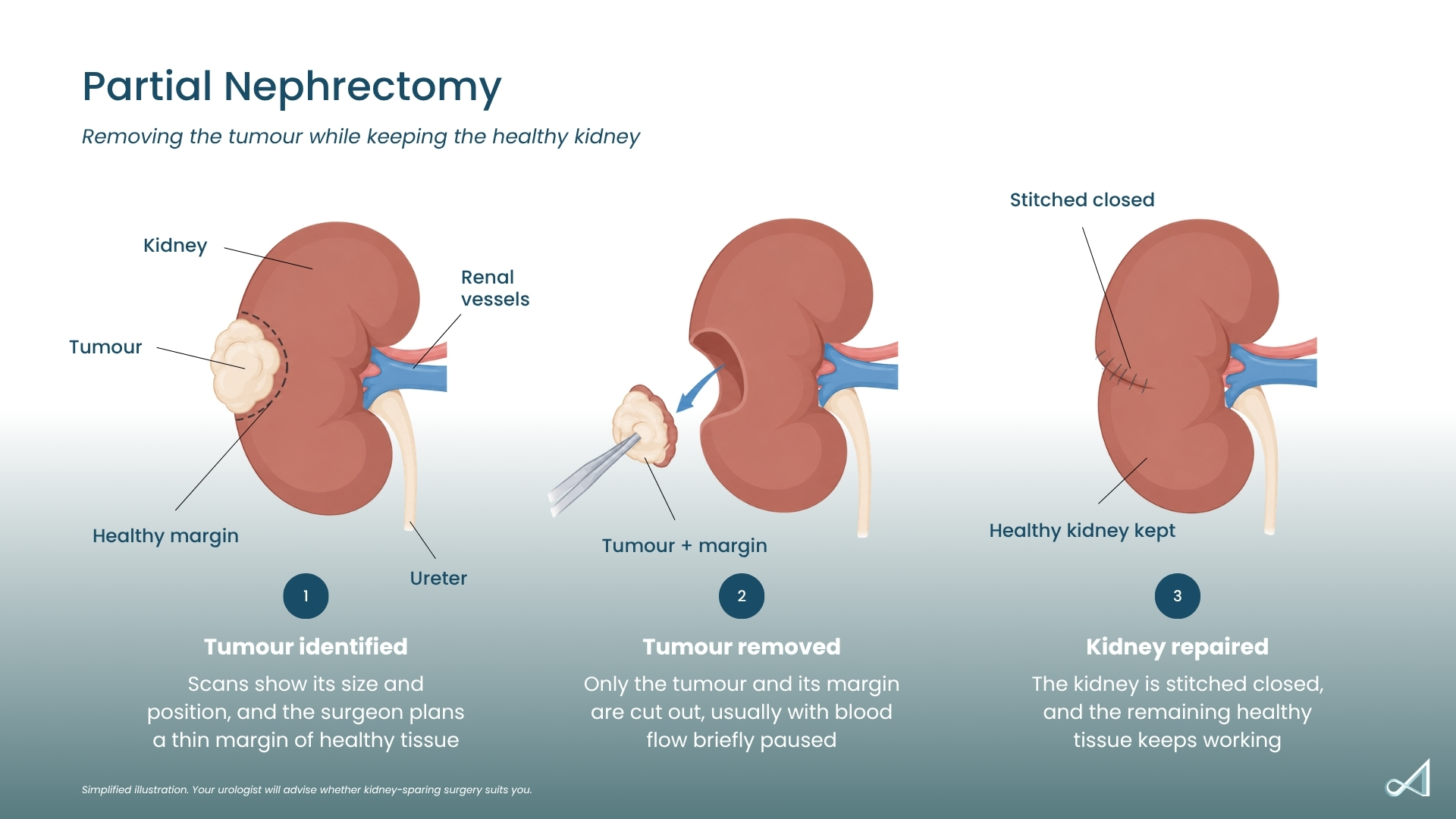 Three-step illustration of partial nephrectomy: a tumour on the kidney is identified with a margin of healthy tissue marked around it, the tumour and margin are removed, and the kidney is stitched closed so the healthy tissue keeps working